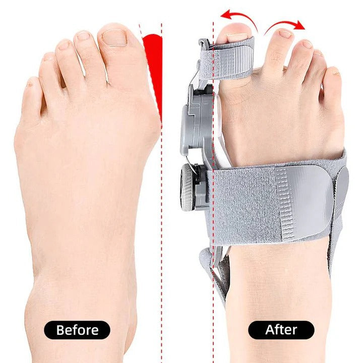 [Hometech] Adjustable Toe Spacer for Foot Alignment Support